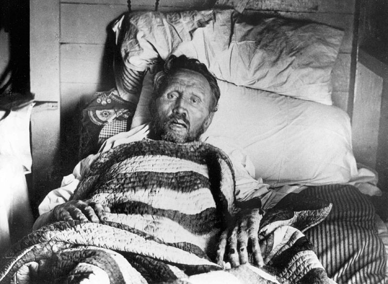 Father Damien, shortly before he too succumed to leprosy. Photo: Sydney B Swift